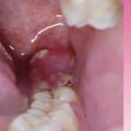 Signs of Complications After Wisdom Teeth Removal