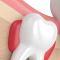 The Benefits of Wisdom Teeth Removal: What You Need to Know