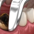 What to Know About Wisdom Teeth Removal