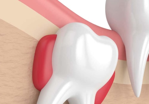 The Benefits of Wisdom Tooth Extraction: Why You Should Consider Removing Your Wisdom Teeth