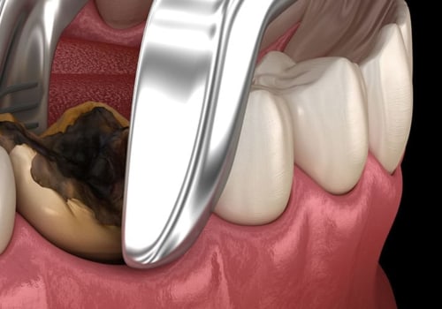 Is it Cheaper to Remove All Wisdom Teeth at Once?